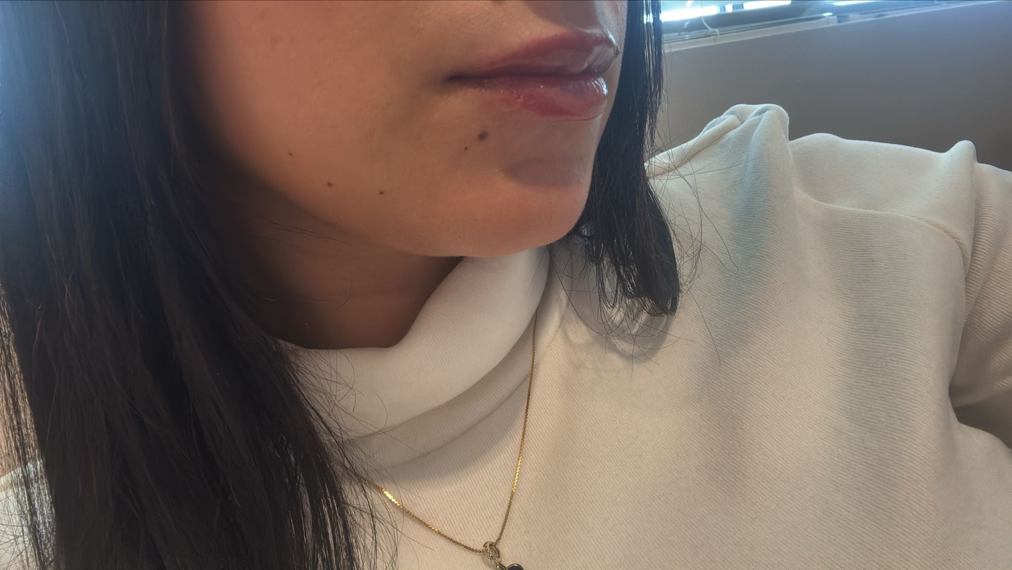 Lip filler level 3 Extremme 🌶️🌶️🌶️